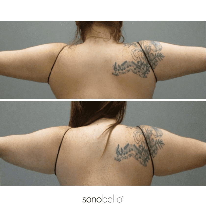 Permanent Arm Fat Removal  Arm Liposuction With AirSculpt®