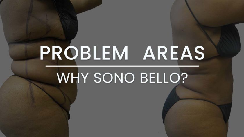 Problem Areas: Why Choose Sono Bello for Laser Liposuction?
