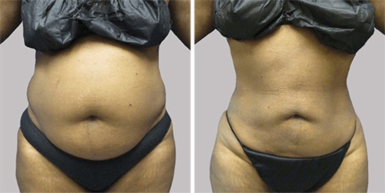 Sono Bello - AbEX, our tummy tuck alternative, is tailored to each patients  needs. First, we use smart liposuction to remove 50-70% of the fat from  treated areas and contour the body