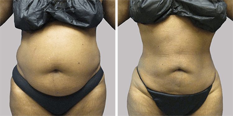 Liposuction Cost Omaha, NE - Omaha Liposuction by Imagen