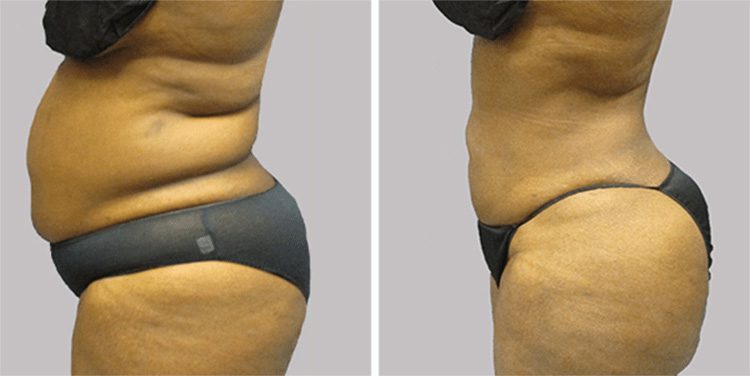 Abdominal Liposuction vs Tummy Tuck - Little Rock, AR - Conway, AR