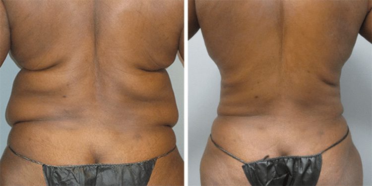 Laser Liposuction Cost | Sono Bello Pricing &amp; Affordability