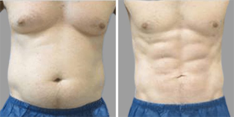 Liposuction for Men Before and After Photo Gallery, Los Angeles, CA