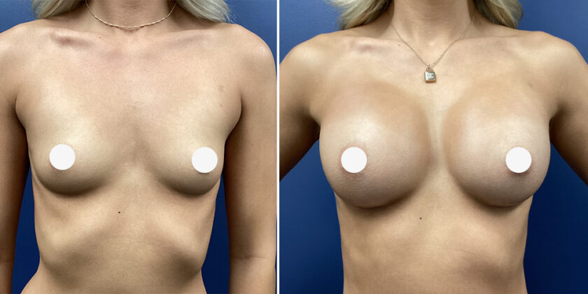 Sono Bello Contour Breast Augmentation Before and After